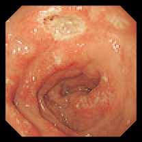 1. ZOLLINGER - ELLISON SYNDROME Zollinger Ellison syndrome is characterized by gastric hypersecretion, ulceration (ulceration) and gastrin-producing tumor.