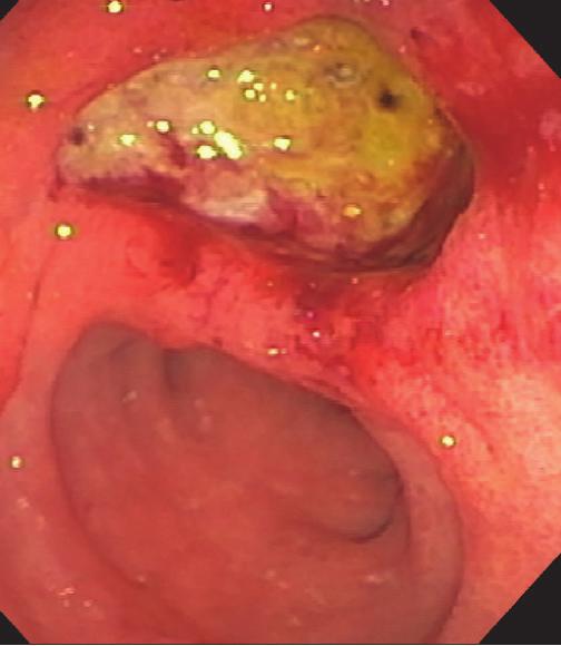 2 Case Reports in Gastrointestinal Medicine endoscopic ultrasound (EUS), contrast enhanced computed tomography (CT), magnetic resonance imaging (MRI), or somatostatin receptor scintigraphy (SRS).