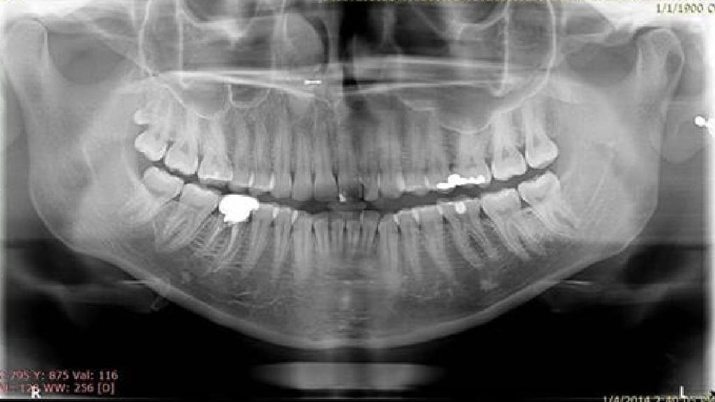 Figure 5: Panoramic radiograph showing ditomolar distal to the upper right third molar. DISCUSSION Dental anomalies are craniofacial abnormalities of form, function or position of the teeth.