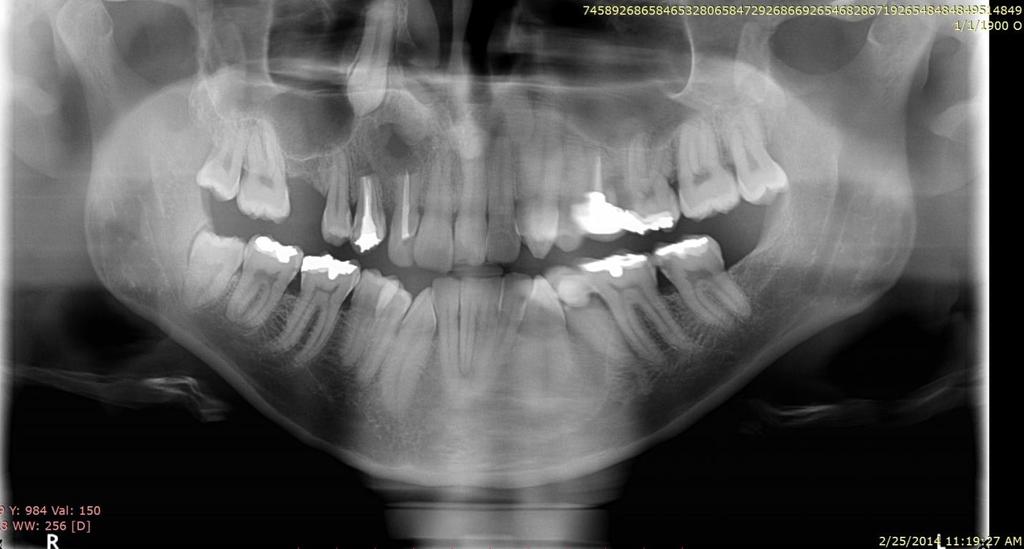 Figure 1: Panoramic X-ray showing upper right impacted canine Figure 2: Panoramic radiograph showing transmigrated lower right canine below the apices of the anterior teeth.