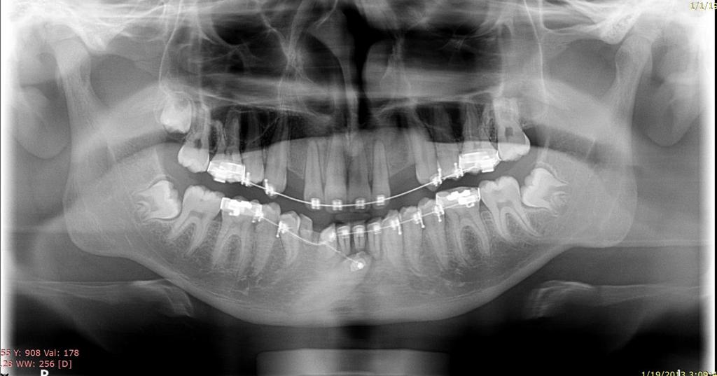 16) to determine the frequency of canine impaction in each quadrant and observing canine transmigration. Any canine was not aligned with the rest of the teeth in occlusion was considered as impacted.