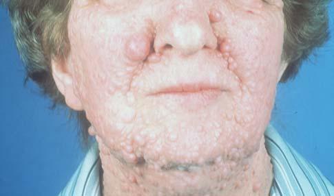 Salivary neoplasms in the lip may simulate, but are usually harder than, mucous cysts. Mucoceles are uncommon in the upper lip; discrete swellings there may well be salivary gland neoplasms. Fig.