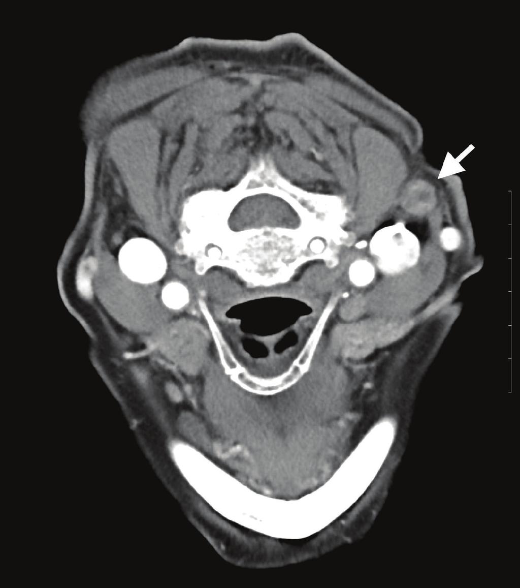 2 Case Reports in Infectious Diseases Figure 1: A cervical Computed Tomography scan at the initial examination showed multiple swollen cervical lymph nodes.