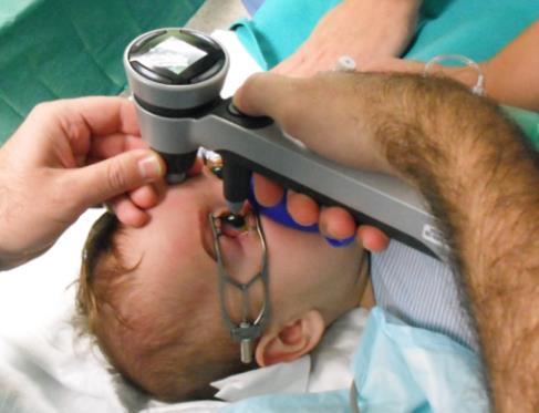 globe (at birth normally 16mm) provided congenital axial myopia is