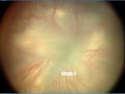 laser treatment to the avascular peripheral retina or injection of Anti- VEGFs intravitreally.