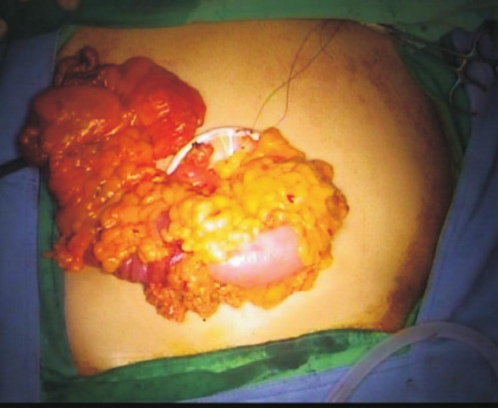 . Specimen extraction from umbilical incision. anastomosis can be checked. At the end of the surgery, the wound was closed by layers, and the length of wound was measured.