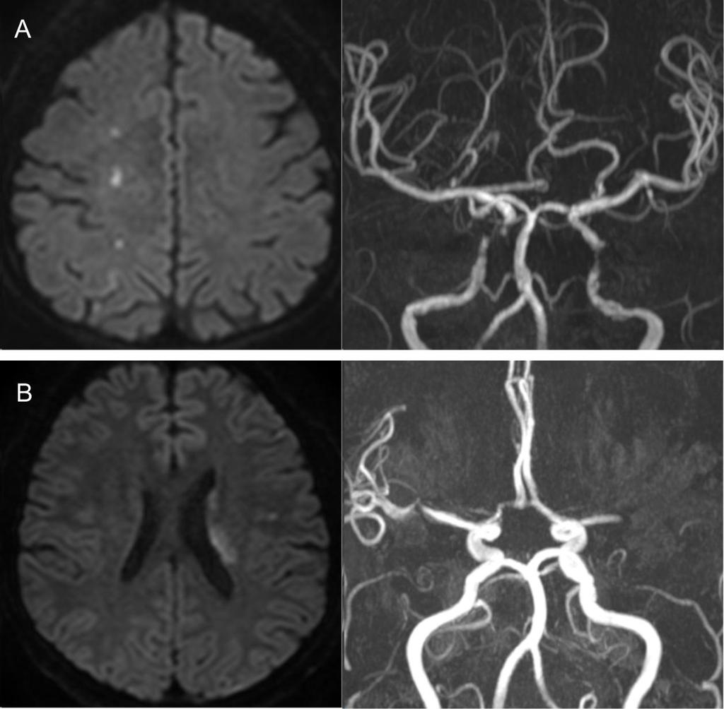 Supplemental figure S1. Examples of patients with non-relevant cerebral atherosclerosis. Diffusion weighted imaging and magnetic resonance angiography are shown.