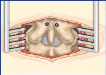 Instability Deformity Anterior column deficiency Facet Screws Goal is to insert perpendicular to orientation of facet