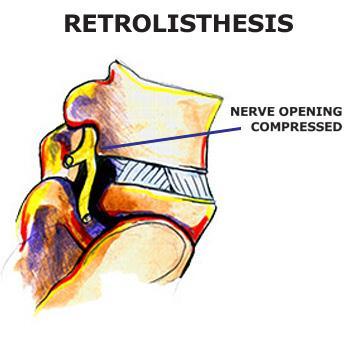 RETROLISTHESIS A retrolisthesis is a posterior displacement of one vertebral body with respect to adjacent vertebrae