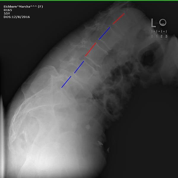 Lumbar Flexion / Extension RED lines denotes vertebral motion greater than the ratable threshold indicating alteration of motion segment integrity.