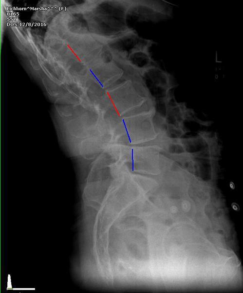 Alteration of motion segment integrity is defined as abnormal translation or angular motion between two adjacent vertebrae. This motion is measured using lateral flexion and extension x -rays.