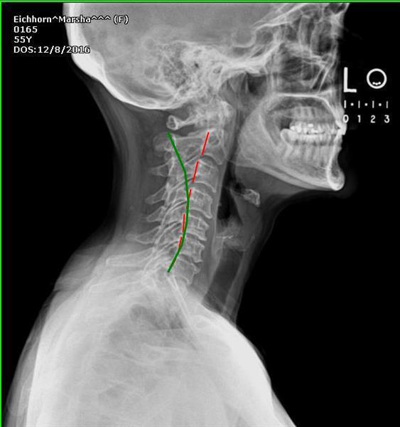Normal Lateral Cervical Curvature The image above shows your vertebral position in red and average or ideal in green.