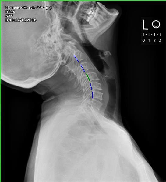 This GREEN line denotes the location of the posterior longitudinal ligament (PLL) with normal alignment to the surrounding vertebrae indicating no significant ligamentous laxity.