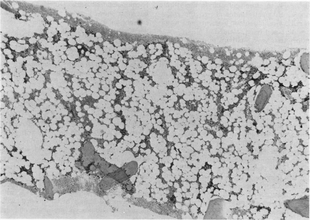 Marrow hypoplasia in adolescence 731 9,r Fig. I Case 1. Bone trephine biopsy showing marked hypoplasia (Haematoxylin and eosin x 40).