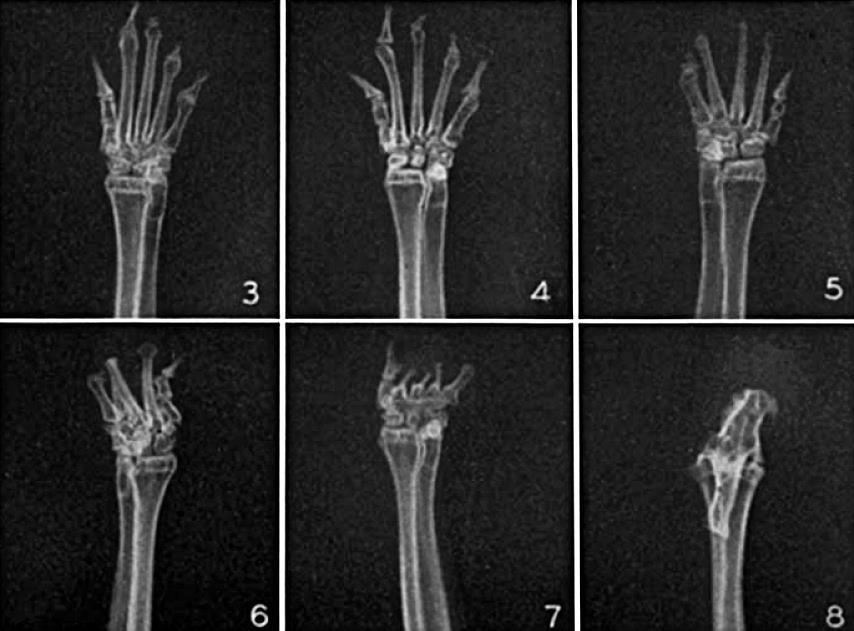 Figure 4: X-rays of the front limbs of bachydacteleous rabbits: loss of one or several digits (3) and metatarsal bones (4, 5, 6, 7). The limb in Figure 8 has only the wrist bone.