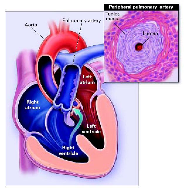 Eisenmenger syndrome Severe Pulmonary Arterial Hypertension associated with Congenital Heart Disease and a large intra- or extra- cardiac shunt.