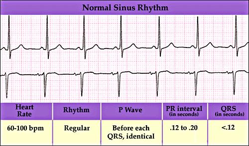 Perform resting ECG before beginning stress test 1. identify contraindications for testing 2.