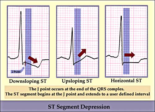 ST segment depression common manifestation of exercise-induced myocardial ischemia.