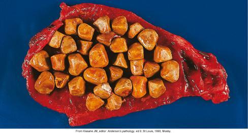 (most common) and pigmented (cirrhosis) Risks Obesity, middle age, female, Native American ancestry, and gallbladder, pancreas, or ileac disease Disorders of the Gallbladder Gallstones Cholesterol