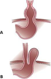 Hiatal Hernia Gastritis A. Sliding hiatial hernia- Stomach moves into thoracic cavity B.