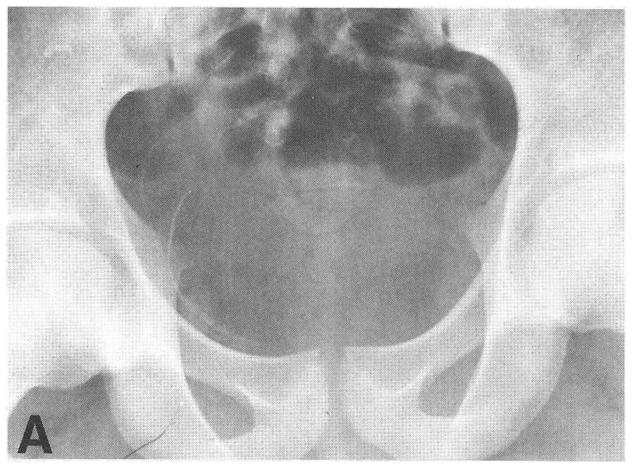 Bladder infection Right sided bladder calcification The calcifications are due to ova in submucosa