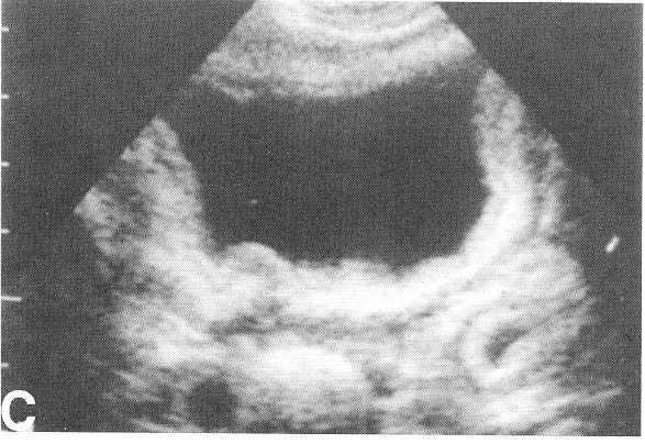 Ultrasound of Bladder Thickened bladder wall Palmer, Seminars in Roentgenology 33:6-25 Almost all forms of schistosomiasis can affect the GU system, but S.