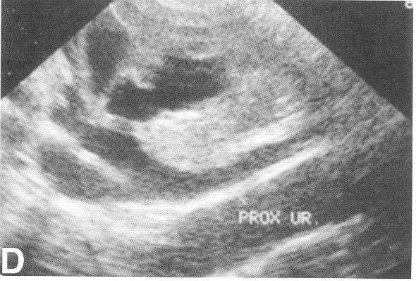 Ultrasound of Kidney Hydronephrosis Hydroureter The hydronephrosis and hydroureter are