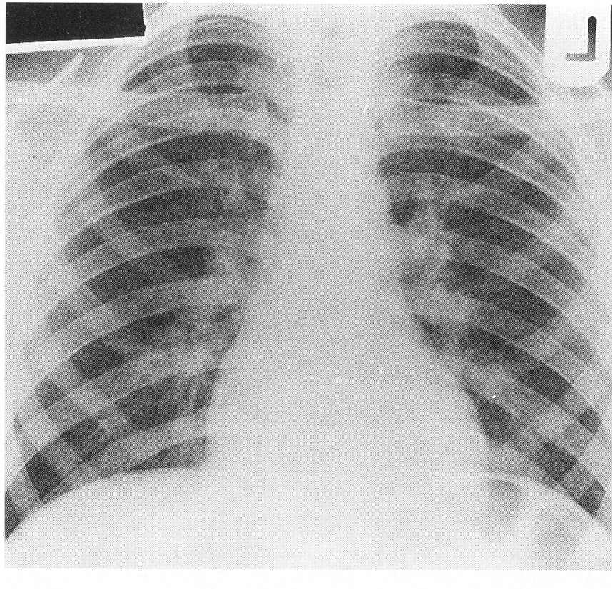 Katayama Radiograph Palmer, Seminars in Roentgenology 33:6-25 Young boy exposed 4 weeks earlier through swimming in African lake (that was designated
