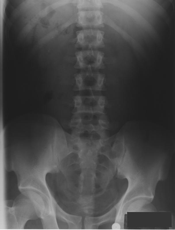 Abdominal Radiograph Notice bladder