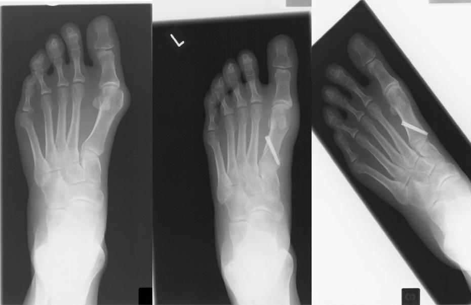 G.E. Fadel et al. / Foot and Ankle Surgery 14 (2008) 21 25 23 Table 1 Radiological indices before and after surgery Preoperative Postoperative Final review IM angle 17.38 (12 208) 10.38 (0 168) 11.