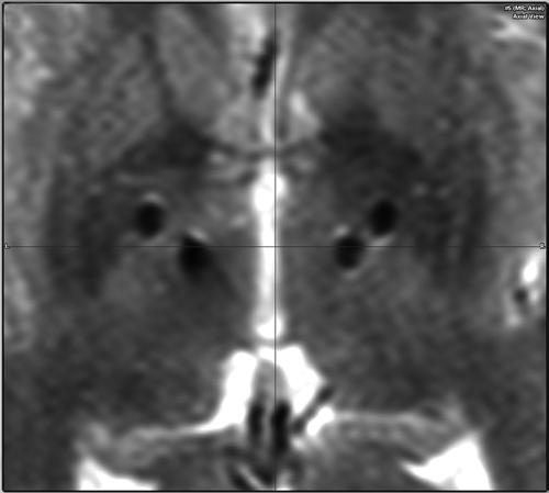 L. Schjerling et al. Fig. 1. Postoperative MR image demonstrating the position of the implanted electrodes in the axial plane. as seen on T2-weighted MR images (Fig. 2).