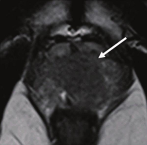 ISRN Radiology 5 (a) (b) (c) Figure 3: Patient with high-risk prostate cancer.