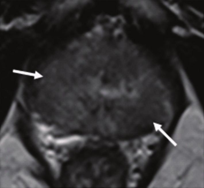 6 ISRN Radiology (a) (b) (c) Figure 4: Patient with low-risk prostate cancer.