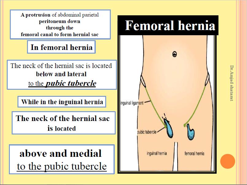 **There are two types of groin hernia; the femoral hernia and the inguinal hernia. But how can we differentiate between the inguinal hernia and the femoral hernia?
