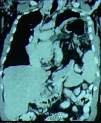 Figure 3 Figure 3: Coronal reformatted CT scan image demonstrate herniation of the spleen into the left hemithorax through the defect in the diaphragm.