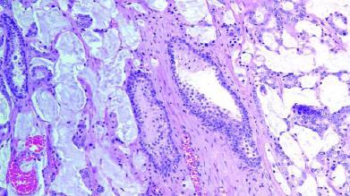 Prostate cancer: Adenocarcinoma variants Prostatic duct