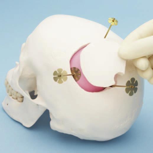 3 Replace cranial bone flap Replace the cranial bone flap to its original position.
