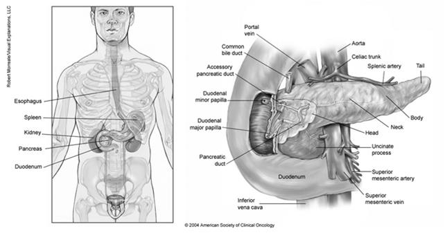 pancreas subsite in which tumor arises Pancreatic Tumor