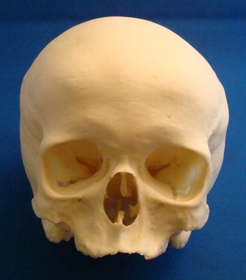 Human Female Dwarf Skull, Achondroplasia Product Number: Specimen Evaluated: Skeletal Inventory: BCD-279 Original Specimen One intact cranium