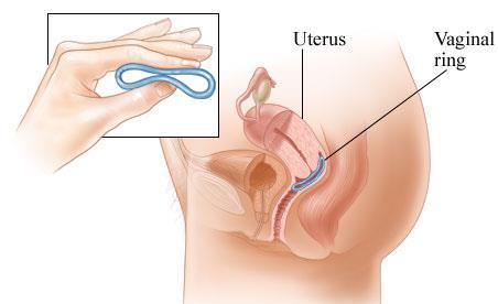 Vaginal rings Vaginal rings offer the flexibility of controlled release of the drug