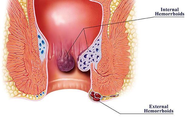 Rectal drug delivery Local action: This is desired or the local treatment