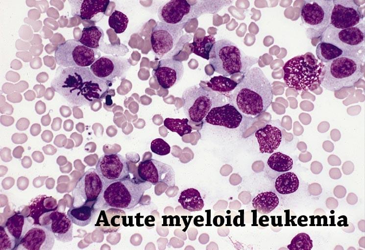 Acute Myeloid Leukemia Most common acute leukemia affecting adults Incidence increases with age Symptoms include: