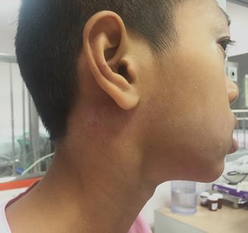 Case 1: A 12 Year- Old Boy with Admitted June 2015 Neck Mass for 2 Mo ม ก