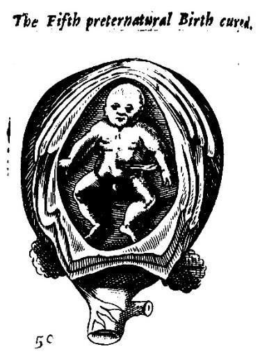 Illustrations Both Wolveridge and Rueff introduced an element of confusion in their sections on natural (head) presentation due to their addition of an extra image of a fetus presenting by the