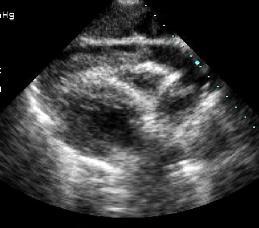 Limit of pericardial