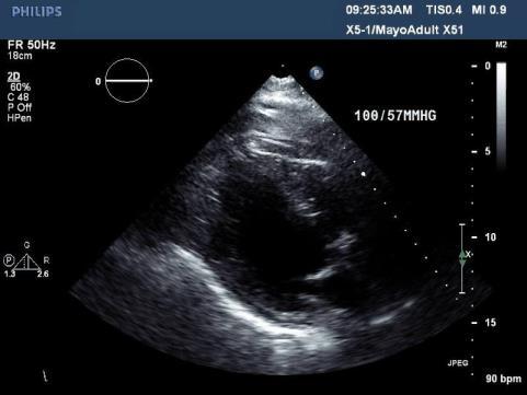 Case #6 77 yo man with severe aortic