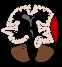 Cerebral herniation Supratentorial herniation 1. Uncal 2.