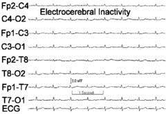 Completed if clinical exam inconclusive or apnea test not completed in its entirety Cerebral angiogram EEG Transcranial doppler 1 st exam performed at least 24 hours following CPR or brain injury