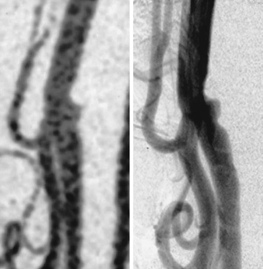 fresh multiple infarcts in the right cerebral hemisphere at 7 hours after a third ischemic event manifesting as left hemiparesis (right). Fig. 2 Case 1.