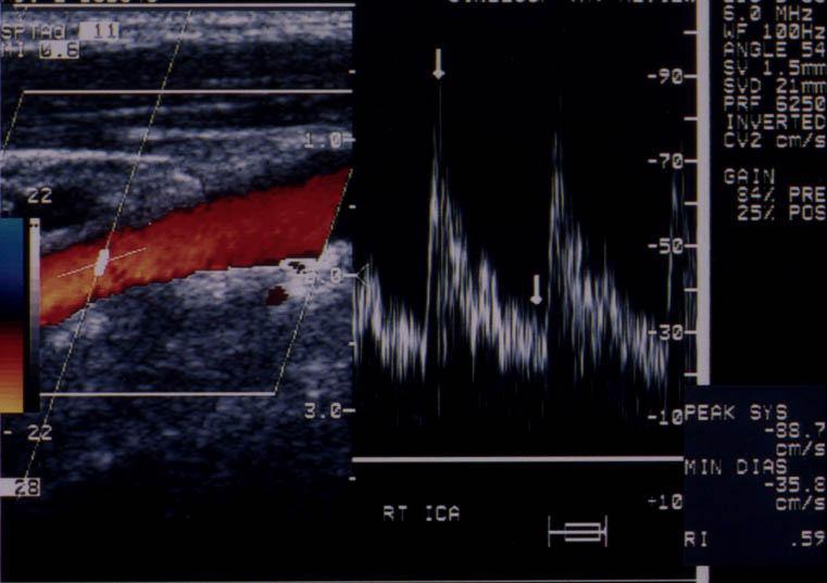 Carotid Ultrasound: Improving Ultrasound